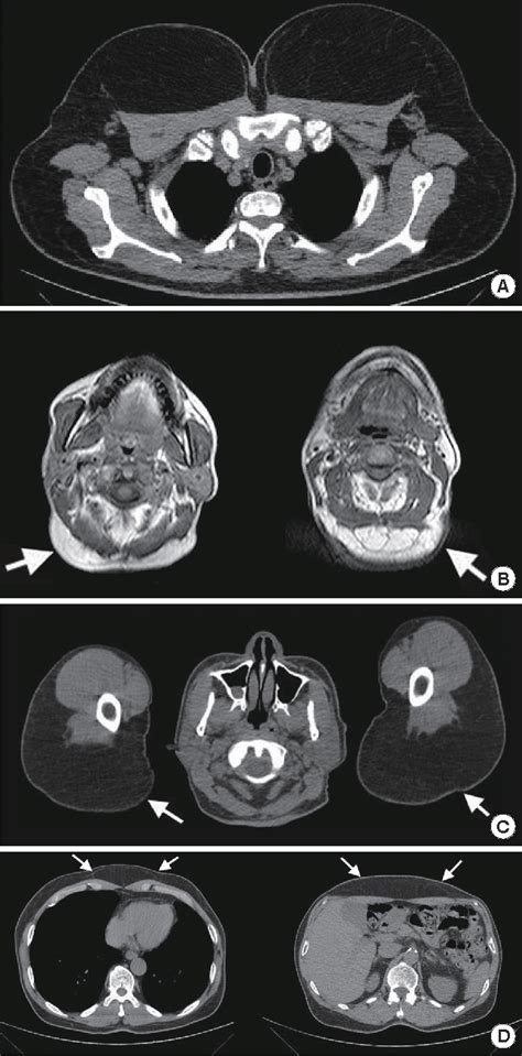 Figure 2 From Multiple Symmetric Lipomatosis Madelungs Disease