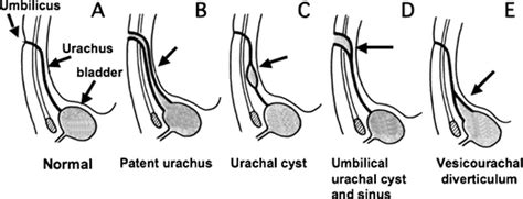 Laparoscopic Excision Of Urachal Cyst Found At Preoperative Examination