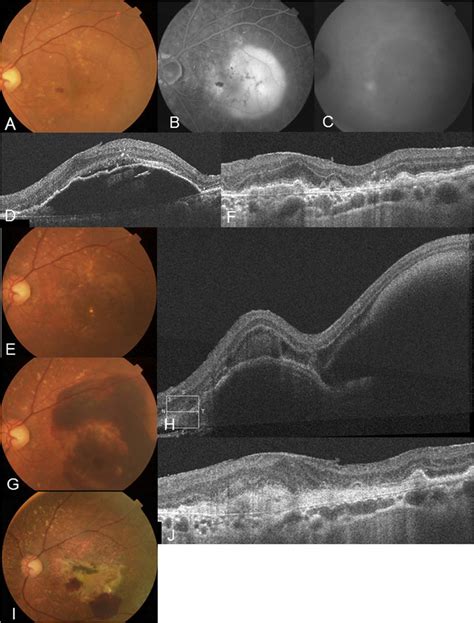 An 84-year-old man presented with metamorphopsia in his left eye. (A) A ...