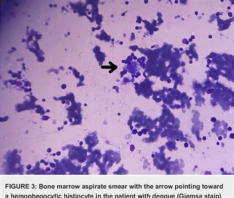 Figure 3 From Secondary Hemophagocytic Lymphohistiocytosis A Series Of