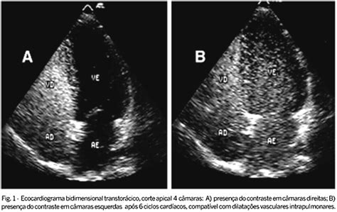 SciELO Brasil A ecocardiografia contraste no diagnóstico de