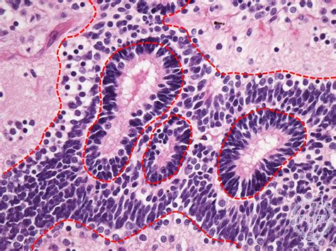 Teratoma Histology