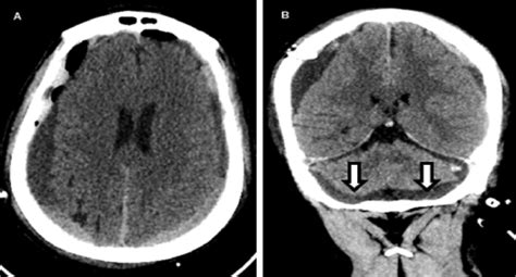 A Postoperative Axial Ct Scan Showing Bilateral Subdural Collection