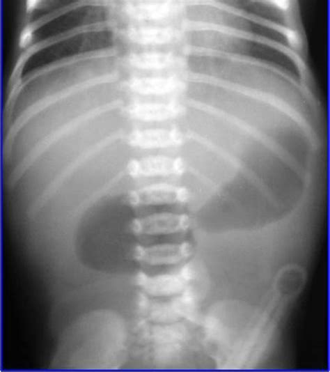 Duodenal Atresia Double Bubble Sign On X Ray Radrounds Radiology