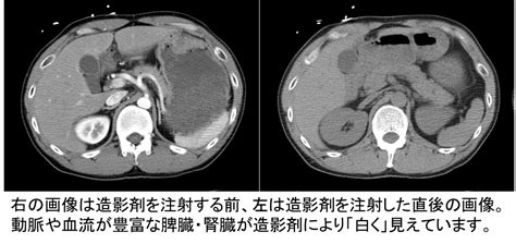 癌 Ct検査 造影剤