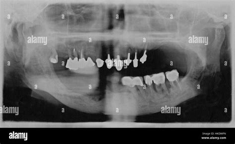 X Ray Tooth Hi Res Stock Photography And Images Alamy