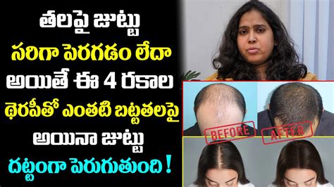 హెయిర్‌ గ్రోత్‌ను పెంచే థెరపీలు ఇవే Bald Head Hair Growth Treatment