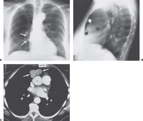 Mediastinal Masses Radiology Key