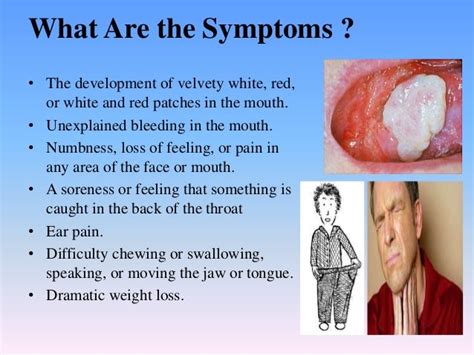 Gum Cancer Symptoms Pictures Let S Talk About Oral Cancer Moreover Patients Who Have