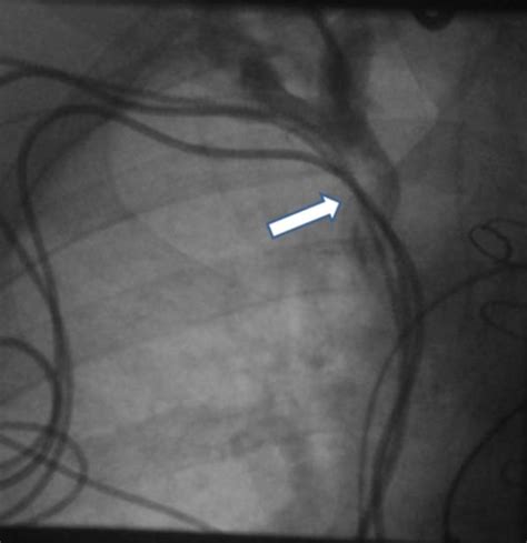 Venogram Demonstrating Severe Obstruction Of The Left Svc And Download Scientific Diagram