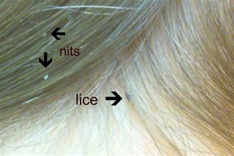 Head Lice And Nits The Symptoms And Treatment Netmums