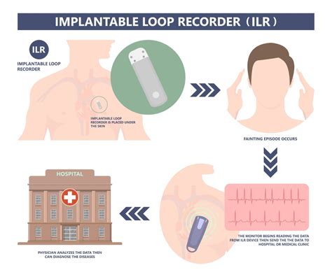 Monitor Card Aco Implantable Mci My Rhythm Device