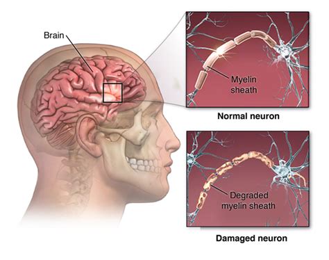 Healthy Brain Vs Ms Brain