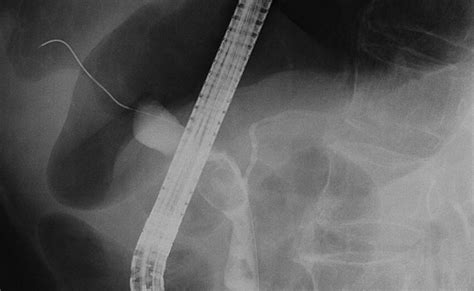 Endoscopic Hemoclip Placement For Post Sphincterotomy Bleeding ...