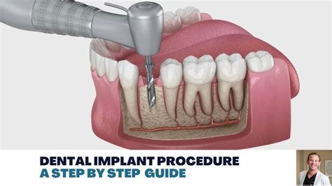 Dental Implant Procedure Steps