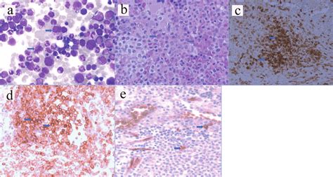 A Hematoxylin And Eosin Staining From Aspirate Arrows Pointed To