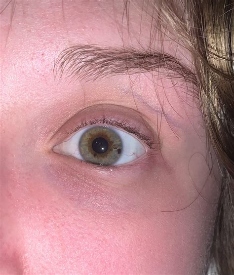 My More Interesting Eye Central Heterochromia And A Freckle What