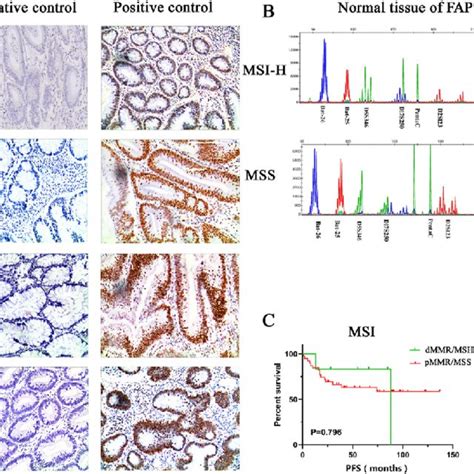 Ihc And Pcr Testing Of Microsatellite Instability Status And