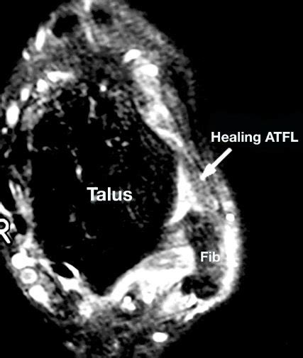 d. MRI of ATFL 6-month post PRP injection. | Download Scientific Diagram