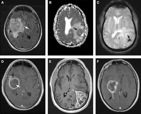 Typical MRI features of gliosarcomas. a FLAIR image demonstrating a ...