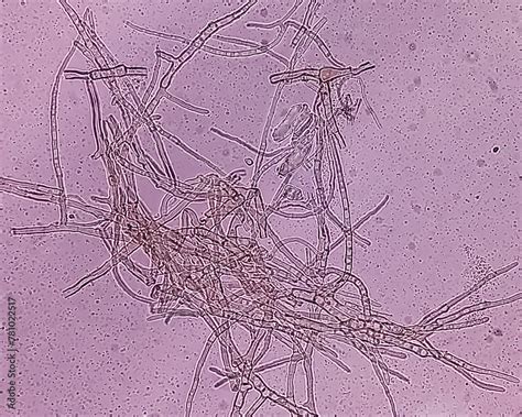 Microscopic Fungi Malassezia Furfur Showing Yeast Cells And Hyphae Dermatophytes Nail