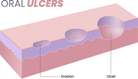 illustration of oral ulcer diagram 25794533 Vector Art at Vecteezy