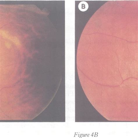 B Choroidal Inflammation In Apmppe A Infiltration Round A Choroidal