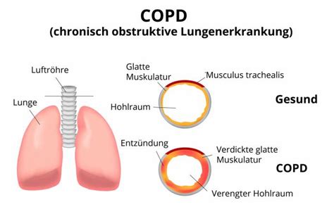 Copd Chronisch Obstruktive Lungenerkrankung