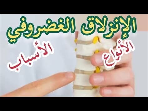 الإنزلاق الغضروفي أنواعه أسبابه و طرق العلاج YouTube