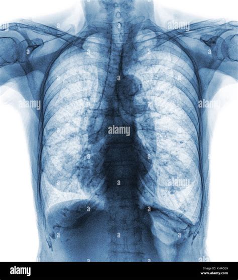 Radiographie Thoracique Normale De L Ancien Patient Vous Pouvez Voir