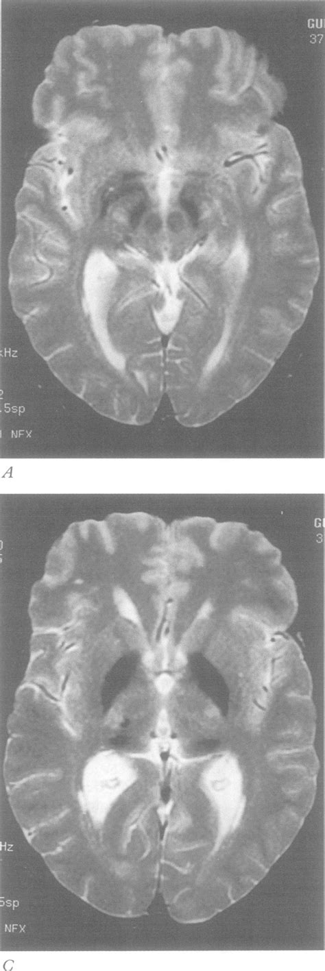 Mri Of Brain Axial Section T2 Weighted Images At The Level Of The Download Scientific Diagram