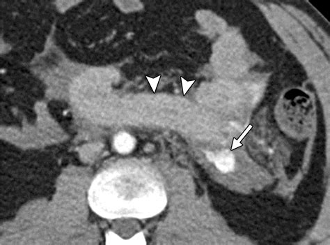 Ct Findings Of Acute Small Bowel Entities Radiographics