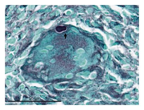 Grocotts Methenamine Silver Stain Of Prostate And Seminal Vesicles Download Scientific Diagram