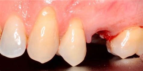 Implantes Dentales En Vitoria Gasteiz Cl Nica Dental Mozas