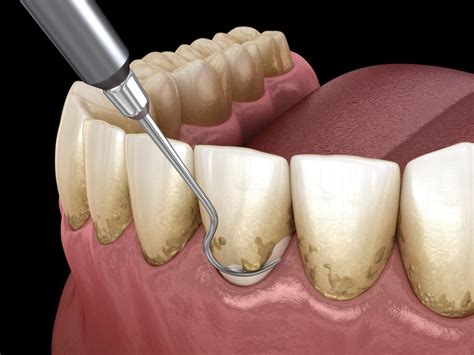 Gum/Periodontal Disease Treatment - Littleton, MA - Nashoba Family Dentists