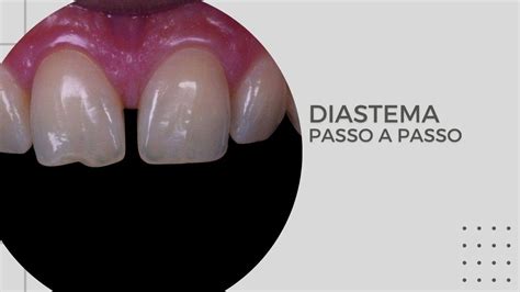 Fechamento De Diastema Com Resina Youtube