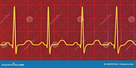 Electrocardiogram Ecg Displaying Sinus Tachycardia D Illustration