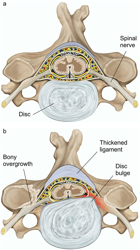 Cervical Laminectomy