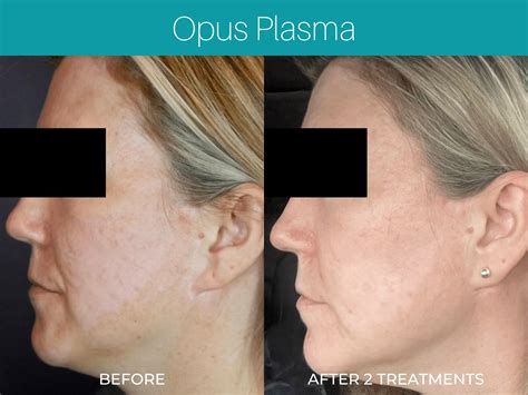 Opus Plasma Danyo Plastic Surgery