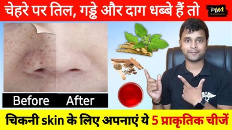 Face Par Daag Dhabbe Kaise Hataye Skin Par Til Kaise Hataye Face Pr