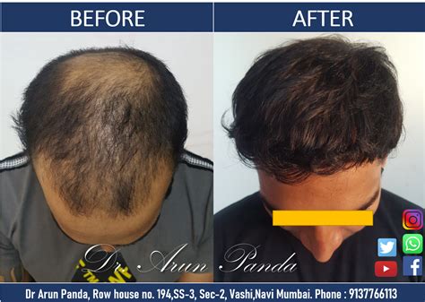 Hair Transplant Navi Mumbai Patients 100 Success Rate