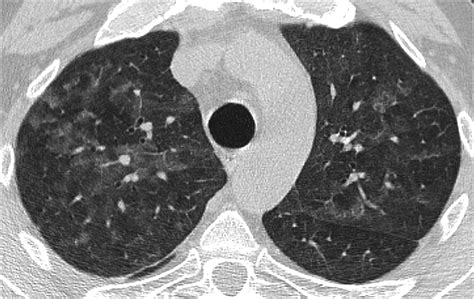 Pneumocystis Jirovecii Pneumonia At Chest High Resolution Computed Tomography Hrct In Non Hiv