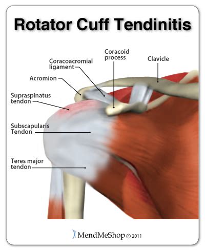 Tendinopathy Of The Supraspinatus Tendon Hot Sex Picture