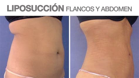 Liposucci N Flancos Y Abdomen Antes Y Despu S Anabel Youtube