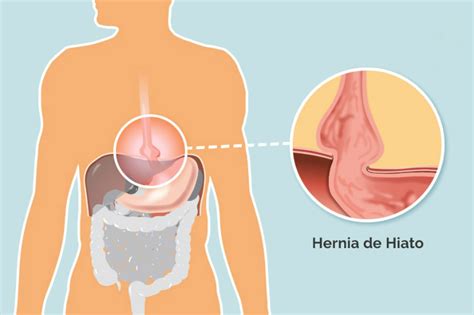 Fui Operado De La Hernia Hiatal Dr Arturo Martinez