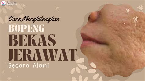 Mau Tahu Cara Menghilangkan Bopeng Bekas Jerawat Secara Alami Simak