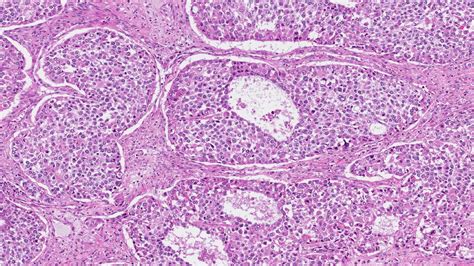 Juvenile type granulosa cell tumour | MyPathologyReport.ca