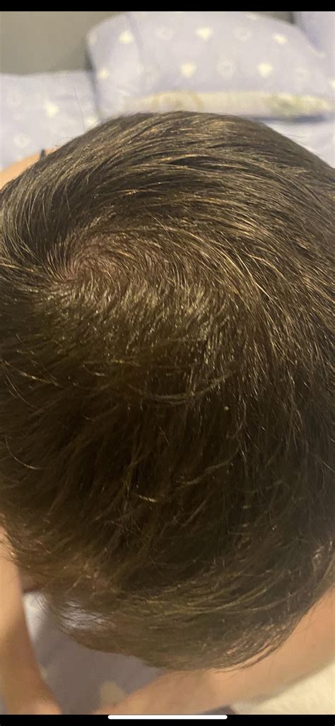 Finasteride And Minoxidil 3 Months R Tressless