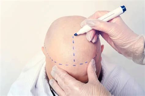 Best Hair Transplant Surgeon In Riyadh