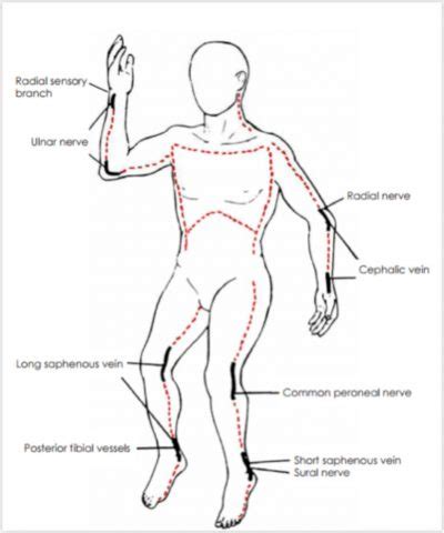 Escharotomy Rcemlearning India